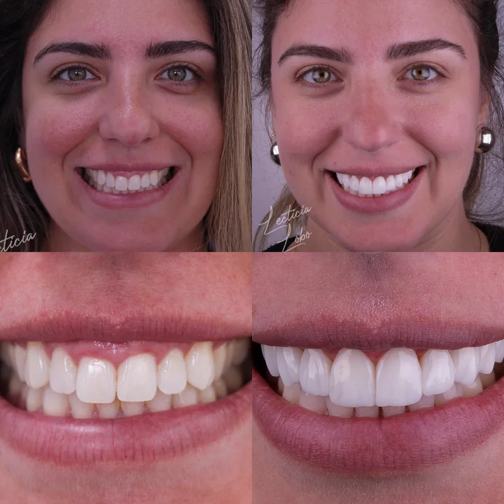 Antes e depois de facetas no sorriso