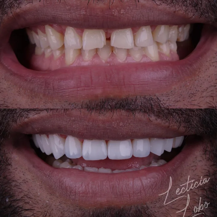 Antes e depois de facetas no sorriso