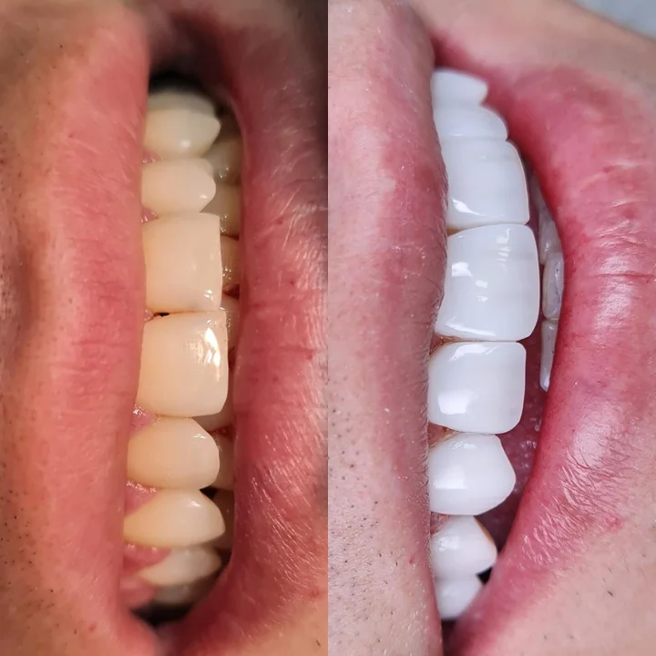 Antes e depois de facetas no sorriso