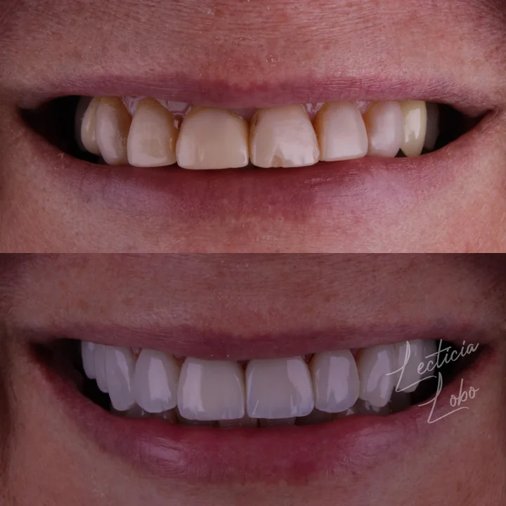 Antes e depois de facetas no sorriso