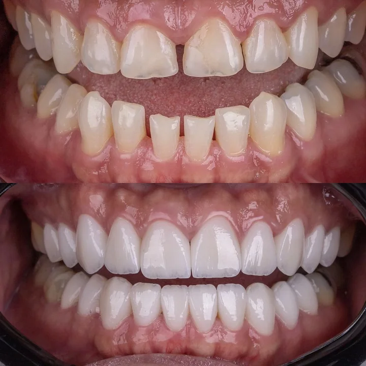 Antes e depois de facetas no sorriso