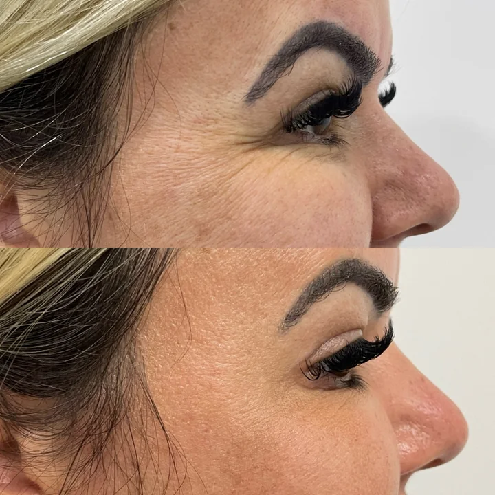 Antes e depois de toxina botulínica, linhas ao redor dos olhos