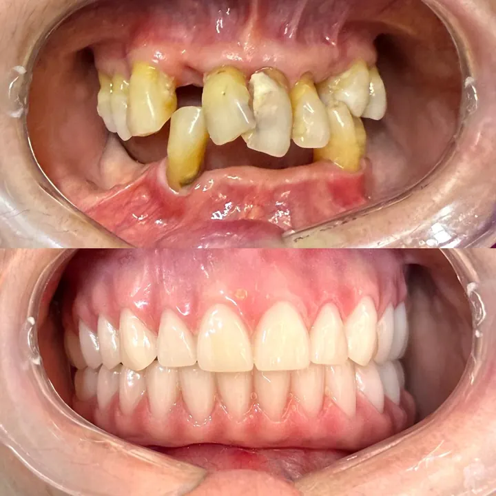 Antes e depois de protocolo com carga imediata, arcadas superior e inferior