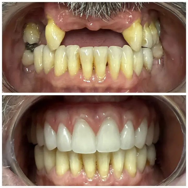 Antes e depois de protocolo com carga imediata, arcadas superior e inferior