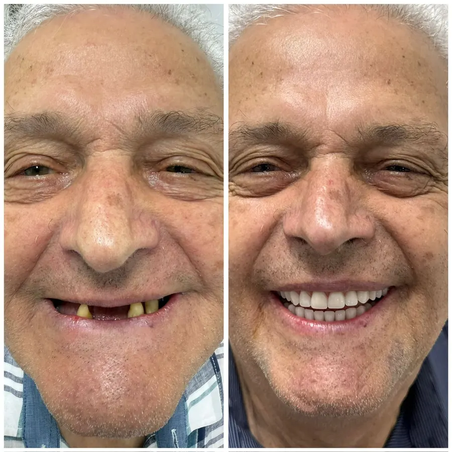 Antes e depois de protocolo com carga imediata, sorriso completo