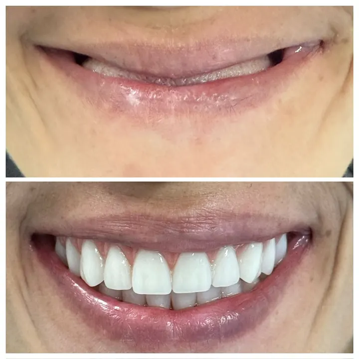 Antes e depois de protocolo com carga imediata, sorriso