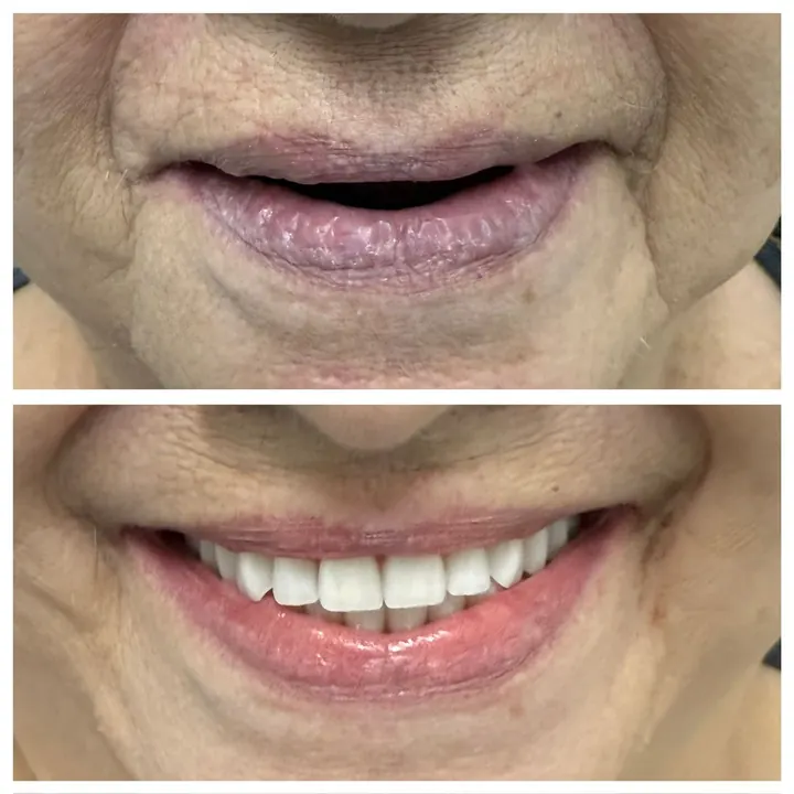 Antes e depois de protocolo com carga imediata, sorriso