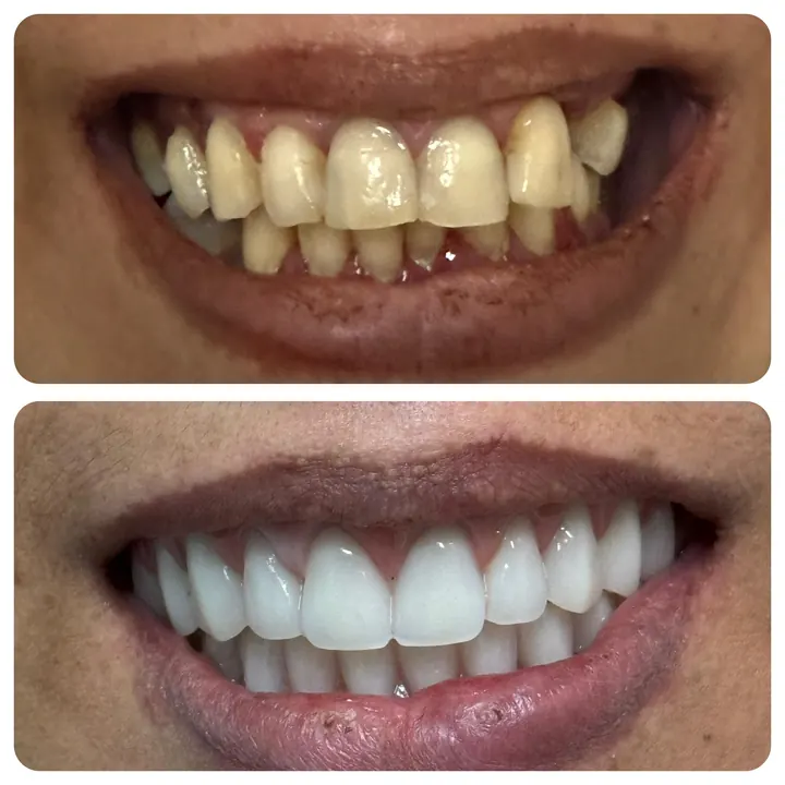 Antes e depois de protocolo com carga imediata, sorriso